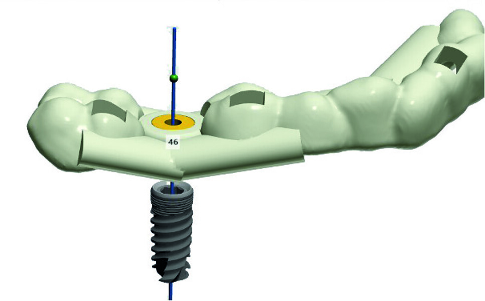 Fig. 10 : Positionnement de la douille MIS correspondant à l’implant choisi. 