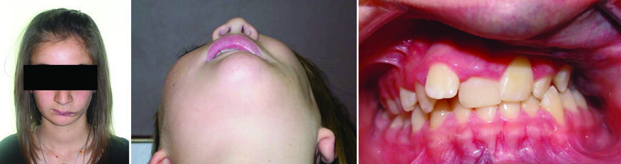 Figure 7. A 13-year-old girl with hemangioma “infrabulbare” (a) applying excessive pressure on the left maxillary teeth (b) and severely influencing their position (c). 