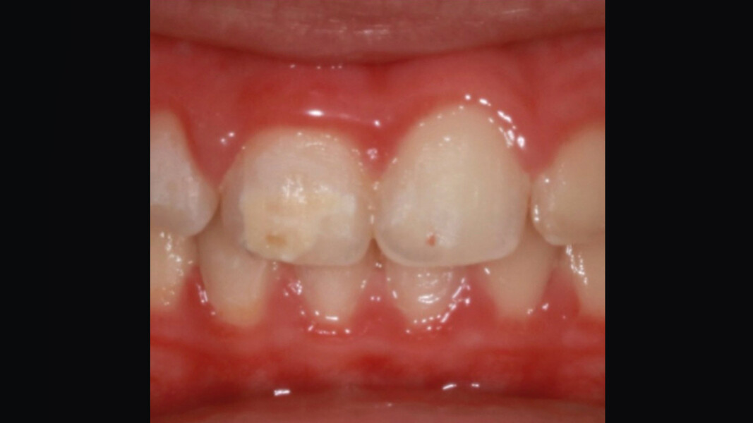 Fig. 2 - Lesione del 1.1 prima del trattamento, dopo la terapia ortodontica.