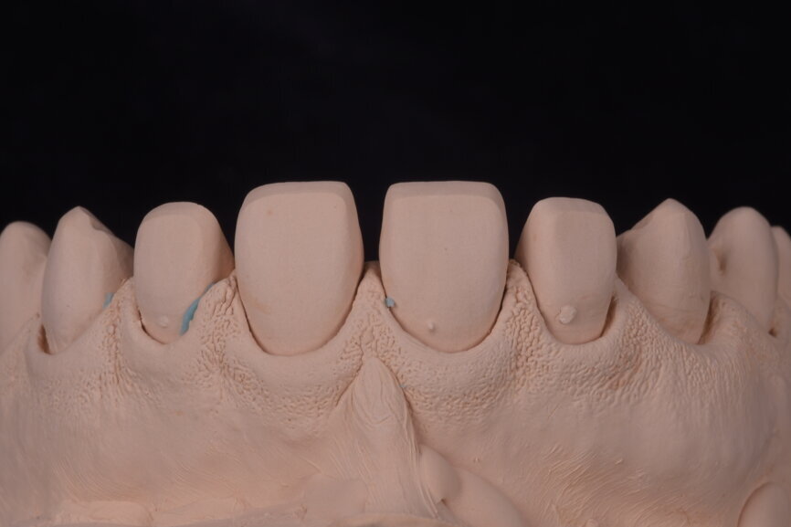 Fig. 60: Master dies after pouring, ready to be sectioned and manually worked.