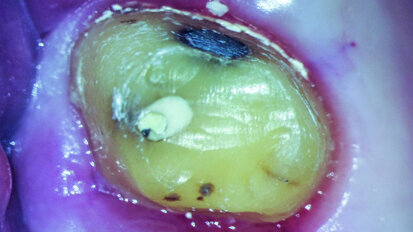 Minimally invasive root canal shaping—A new protocol