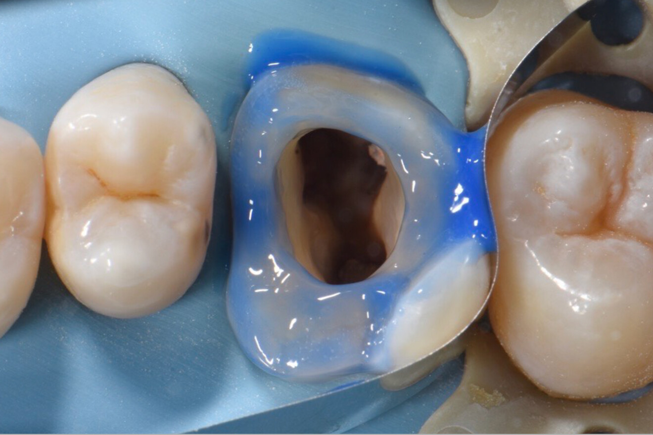 Fig. 20: Selective etching of the enamel margins with phosphoric acid.