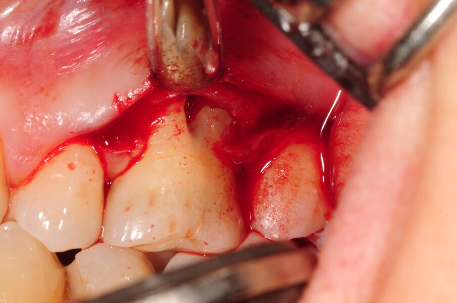 Fig. 5d - Difetto biforcazione vestibolare di 2.6.