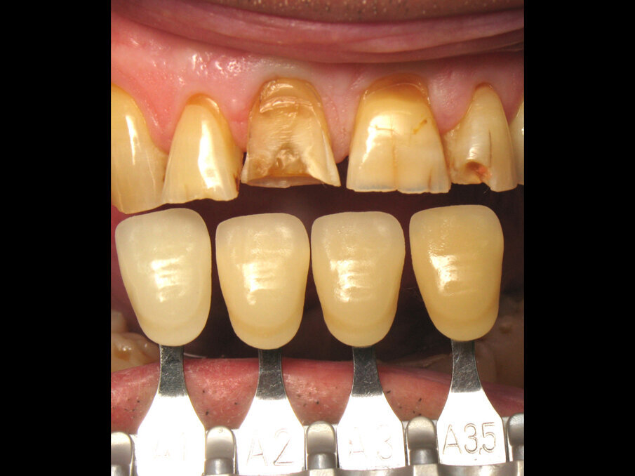 Fig. 10: Pre-op tooth shade.