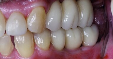 Terapia implantare in tutta sicurezza