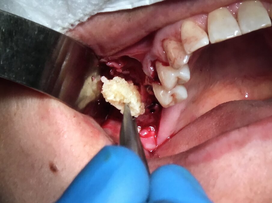 Fig. 17 - Sinus lifting: inserzione di impianti endoossei Multysytem.