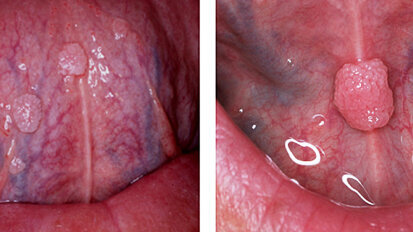 Fig. 3. Condilomas. Son lesiones que se pueden presentar en la mucosa oral, su apariencia es blanda con una superficie parecida a la coliflor. Fig. 3. Condilomas. Son lesiones que se pueden presentar en la mucosa oral, su apariencia es blanda con una superficie parecida a la coliflor.