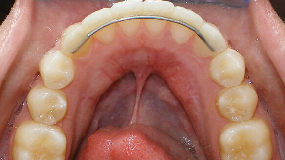 Reliance introduces newest addition to its lingual retention line: Extend LTR