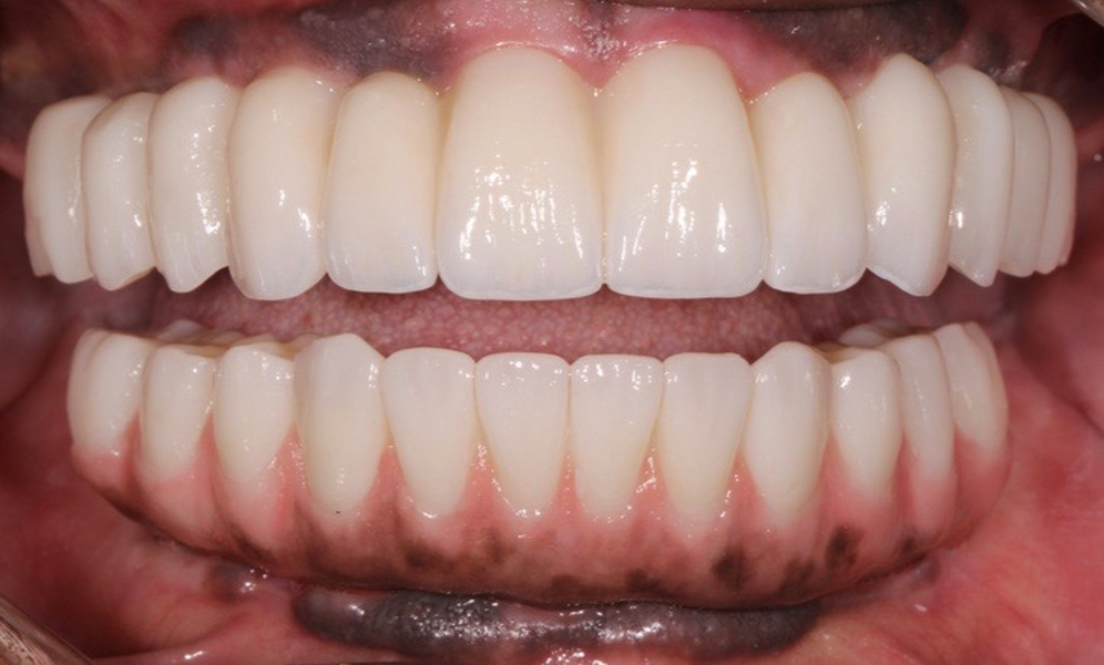 Fig. 33: Frontal view of the completed case.