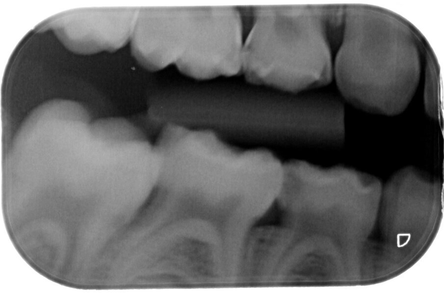 Afbeelding 12a-b. Casus 4: 21-02-18. BWR en BWL. Angstig meisje met pijn bij eten en poetsen bij 84 en 74.