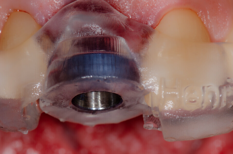 Fig. 13a: Surgical guide in place in the mouth, anterior views.