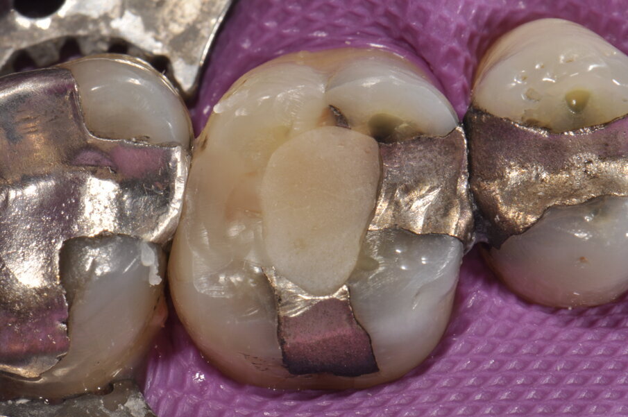 Fig. 1: Situación inicial posterior al tratamiento endodóntico.