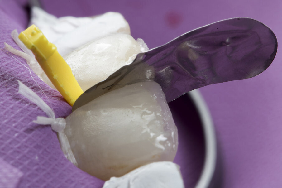 Fig. 10: Thin layer of  Beautifil II LS shade A2  placed after placement of Garrison anterior matrix band with silicon wedge between both central incisors for better contact and contour of the tooth