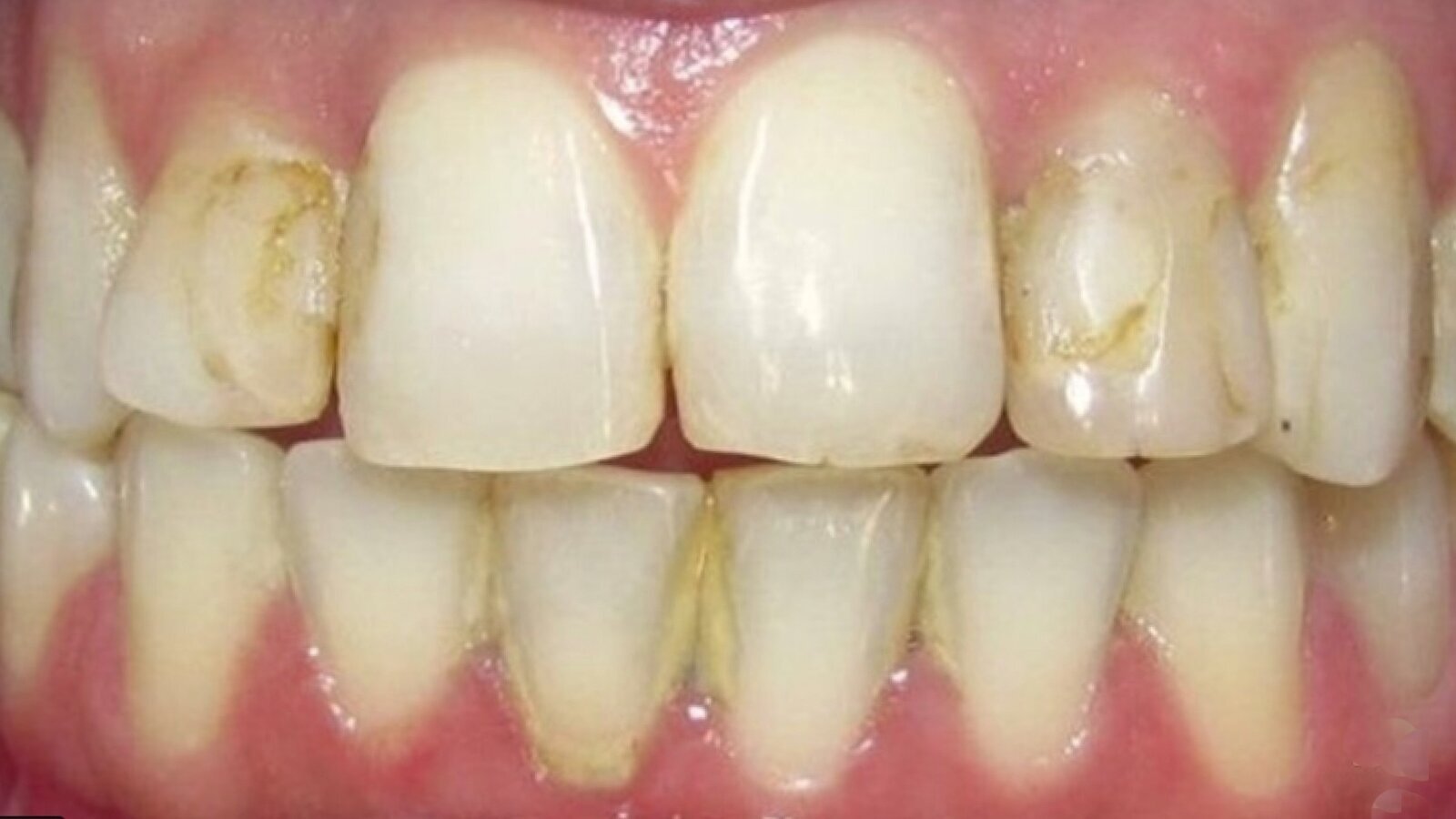 Estética y blanqueamiento dental en la era digital  (Capítulo 10)