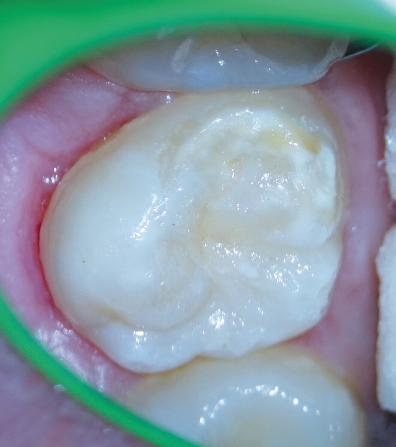 Fig. 10 b : Restauration coronaire adhésive, juste après le retrait de l’isolation. 