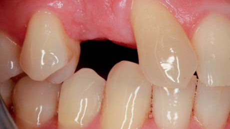 Tratamiento en una visita con CAD/CAM y CBCT