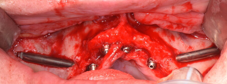 Figg. 27, 28 - Fine intervento: perfetta pianificazione dal modello stereolitografico al risultato finale.