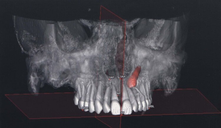 1Ed_Testori_Implants
