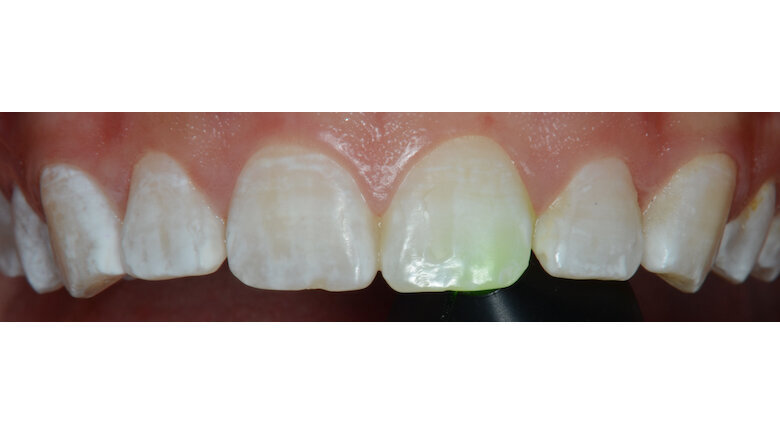 Foto 9. Sector antero superior, antes del tratamiento.
