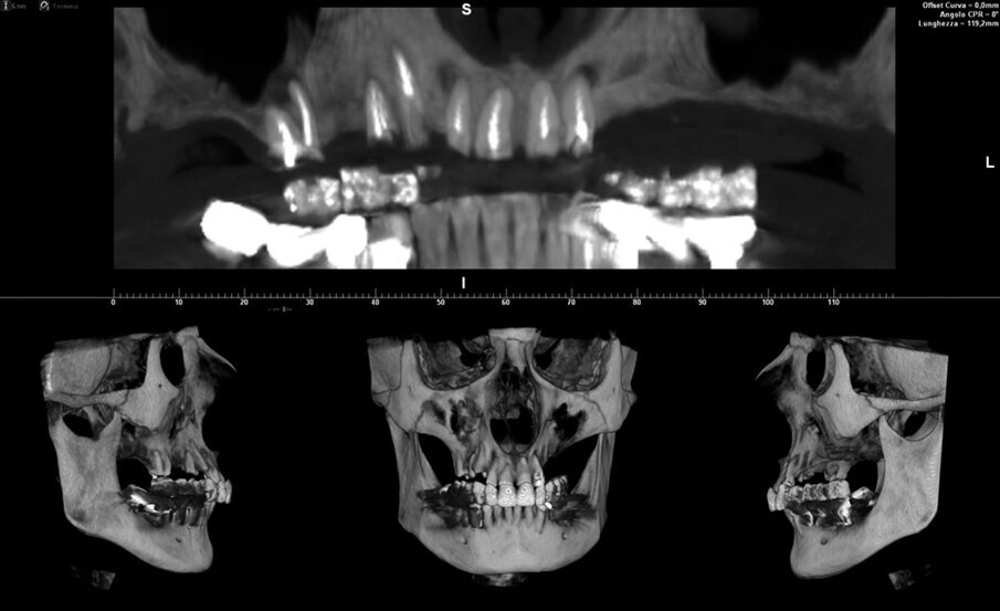 Fig. 1_CBCT e ricostruzione tridimensionale del massiccio facciale della paziente. I sette elementi ancora presenti nel mascellare superiore sono compromessi. 