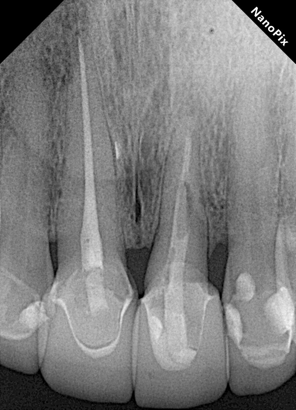 Fig. 8: Four-year follow-up periapical radiograph showing absence of inflammatory signs in the periapical area, absence of signs of root resorption, bone gain in the area of the distal bone crest and a normal and healthy periodontal ligament space. 
