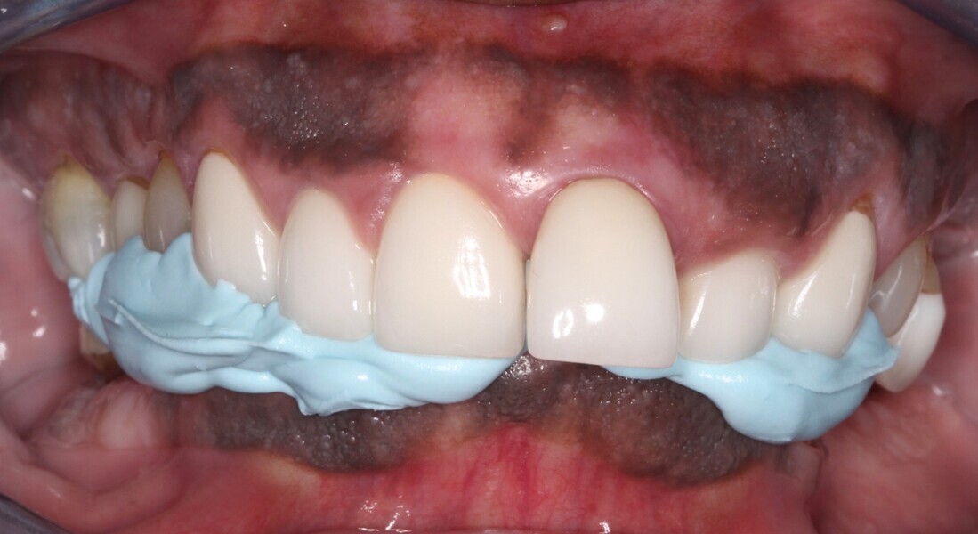 Fig. 11: Frontal view of centric relation bite registration.
