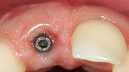Replacement of a single anterior tooth: Surgical procedure and three-year results