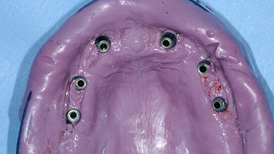 Pianificazione implanto-protesica in un caso clinico complesso