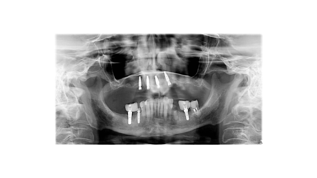Fig. 2_Ortopanoramica di controllo a 40 giorni dall’inserimento implantare post-estrattivo immediato.