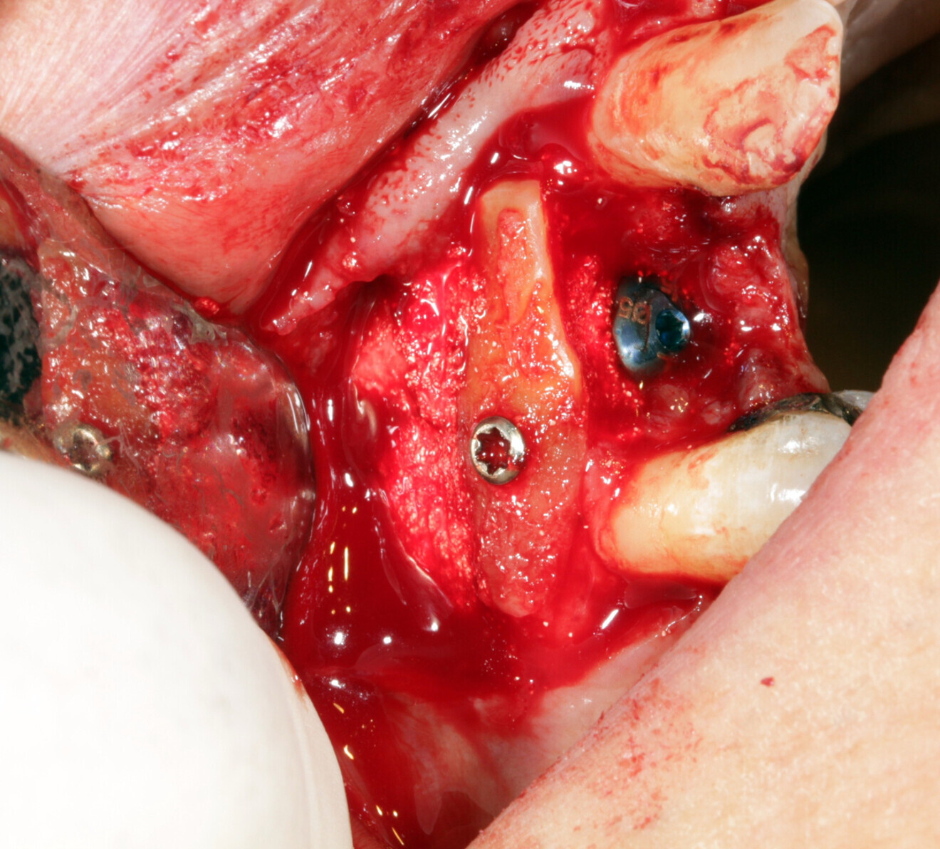 Fig. 17: The space between the root and the implant was filled with a hydroxyapatite-based biomaterial.