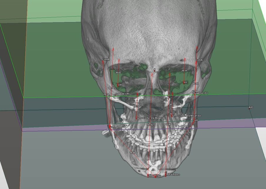 Fig. 5_Controllo post chirurgico della correzione della asimmetria scheletrica. 