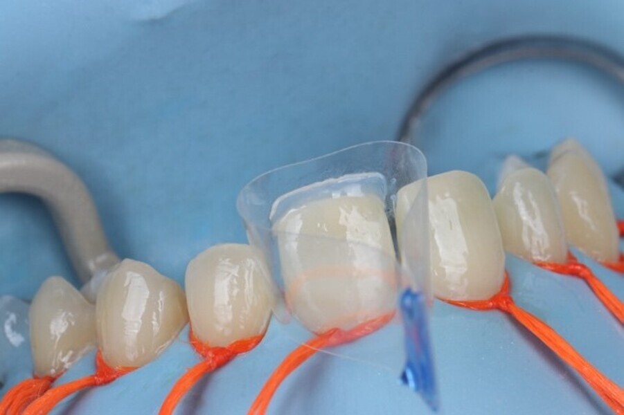 Fig. 3d: The palatal shell created with transparent injectable composite.