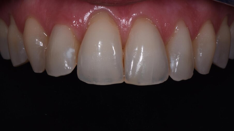 Fig. 13 - Superfici al controllo a 6 mesi dal trattamento d’urto. 