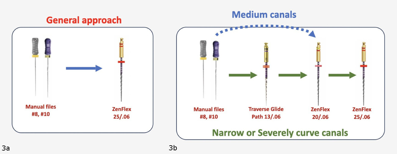 Figs. 3a & b: Adaptive Motion with two different sequences using Kerr Dental files, one for straightforward cases using a single 25/.06 file (a) and the other for more curved and narrow canals (b).