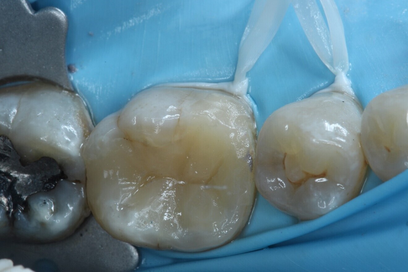 Fig. 15: After composite core build-up.