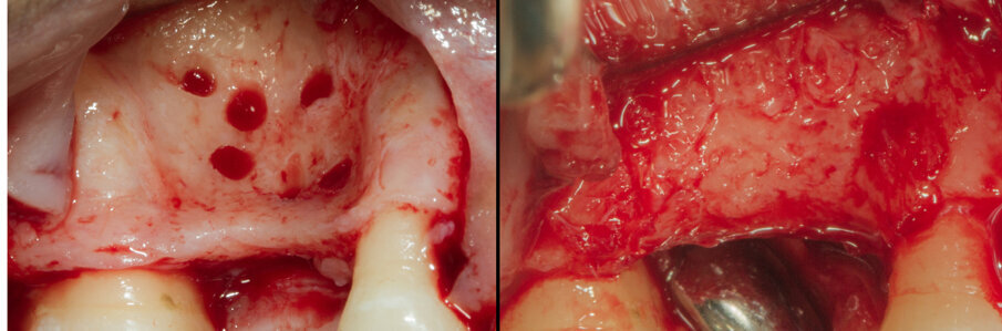 Fig. 21 - Confronto vestibolare tra baseline e sito rigenerato.