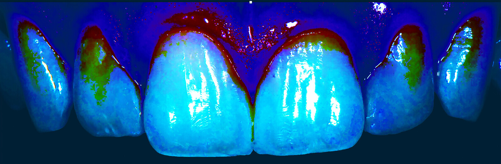 Fig. 19: Frontal image with fluorescence.