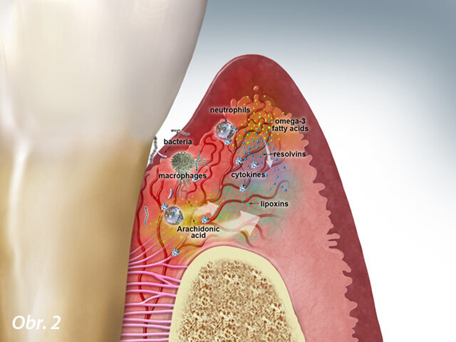 Obr. 2: Aktivní řešení akutní zánětlivé odpovědi – parodontální tkáň: Podnět (bakterie) je odstraněn. Buněčná úroveň: Sulkulární tekutina obsahuje několik oslabených neutrofilů a zbytky bakterií. Biochemická úroveň: Kyselina arachidonová produkuje lipoxiny. Omega-3 mastné kyseliny obsažené ve stravě produkují resolviny. Lipoxiny a resolviny aktivně zastavují zánět.