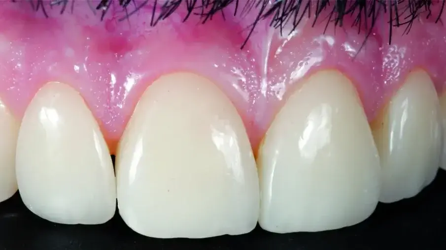 Фиг. 19 Краен резултат, десен страничен изглед.