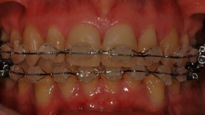 Case Report sulla riabiltazione protesica