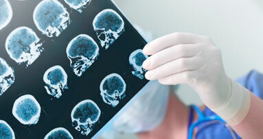 Per mancanza di prove certe ancora poco chiaro il legame tra la salute orale e stato cognitivo