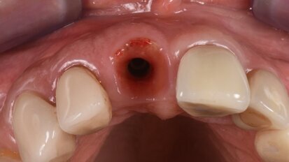 Risoluzione di un fallimento tardivo con impianto immediato e utilizzo di una lamina corticale ossea flessibile