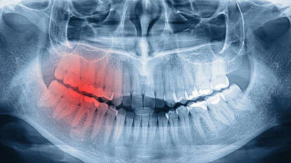 MKG-Chirurgie zwischen Implantologie und Tumorchirurgie