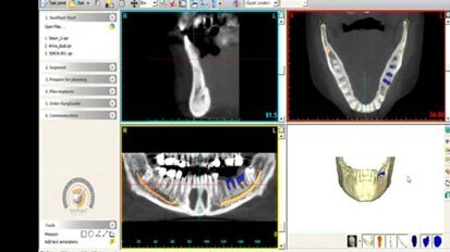 Materialise Dental et Zimmer Dental établissent un partenariat