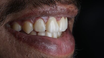 Ortho-Resto Continuum —An Interdisciplinary Approach: Case Report