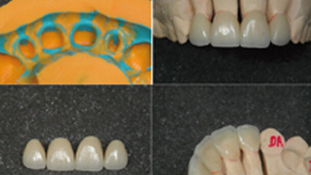 Coronas estéticas anteriores. Caso clínico