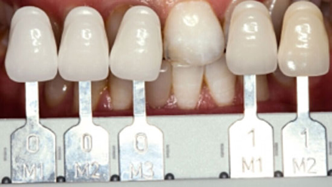 Fig. 2. Mediante la guía VITA Linearguide 3D-MASTER se determinó con precisión el color dental y se pudo seleccionar el correspondiente color de bloque 0M1.