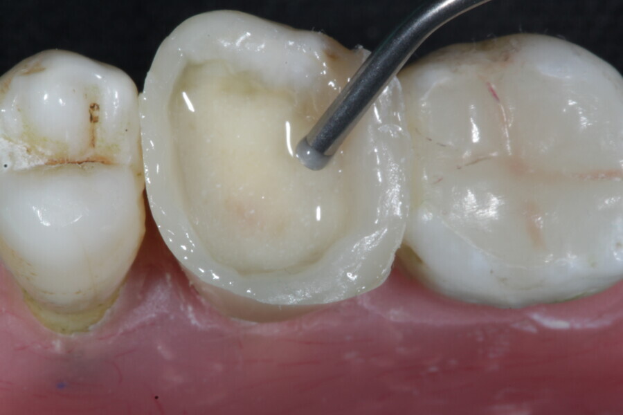 Fig. 38: A thin layer of a fibre-reinforced flowable composite (Fibrafill FLOW) is applied to the floor of the cavity as a liner.