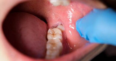 Singapore dentists debate new competency pathway for third molar surgery
