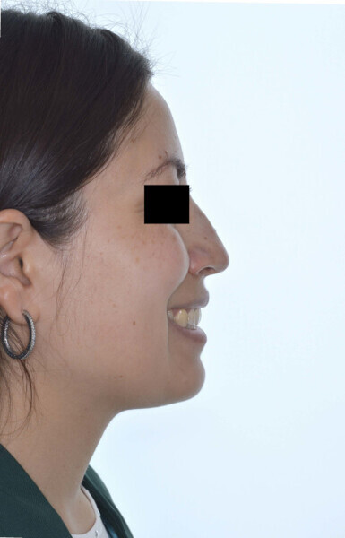 Fig. 9b: Final profile and smile.